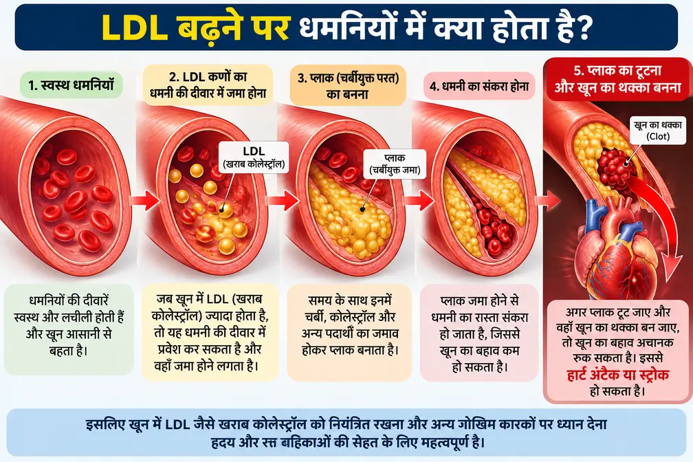 LDL बढ़ने पर धमनियों में प्लाक बनने की प्रक्रिया